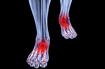 Arthritic foot and ankle care treatment in the Macomb County, MI: Washington Twp. (Romeo, Almont, Oakland Charter Township, Addison Township, Armada, Lenox, Ray, Lakeville, Leonard, New Haven) and Shelby Twp. (Rochester, Utica, Chesterfield, Sterling Heights, Fraser, Clinton Twp, Mt Clemens, Harrison Twp, Warren, New Baltimore) areas
