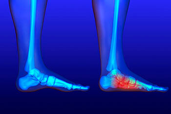 Flat Feet and Fallen Arches Treatment in the Macomb County, MI: Washington Twp. (Romeo, Almont, Oakland Charter Township, Addison Township, Armada, Lenox, Ray, Lakeville, Leonard, New Haven) and Shelby Twp. (Rochester, Utica, Chesterfield, Sterling Heights, Fraser, Clinton Twp, Mt Clemens, Harrison Twp, Warren, New Baltimore) areas