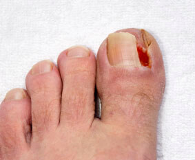 Ingrown toenail specialist in the Macomb County, MI: Washington Twp. (Romeo, Almont, Oakland Charter Township, Addison Township, Armada, Lenox, Ray, Lakeville, Leonard, New Haven) and Shelby Twp. (Rochester, Utica, Chesterfield, Sterling Heights, Fraser, Clinton Twp, Mt Clemens, Harrison Twp, Warren, New Baltimore) areas
