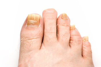 Fungal Toenail treatment and restoration in the Macomb County, MI: Washington Twp. (Romeo, Almont, Oakland Charter Township, Addison Township, Armada, Lenox, Ray, Lakeville, Leonard, New Haven) and Shelby Twp. (Rochester, Utica, Chesterfield, Sterling Heights, Fraser, Clinton Twp, Mt Clemens, Harrison Twp, Warren, New Baltimore) areas
