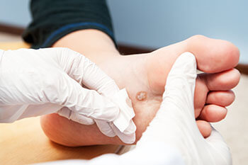 Plantar Warts Treatment in the Macomb County, MI: Washington Twp. (Romeo, Almont, Oakland Charter Township, Addison Township, Armada, Lenox, Ray, Lakeville, Leonard, New Haven) and Shelby Twp. (Rochester, Utica, Chesterfield, Sterling Heights, Fraser, Clinton Twp, Mt Clemens, Harrison Twp, Warren, New Baltimore) areas