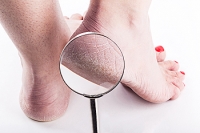 Infections and Cracked Heels