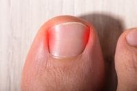 What to Do When You Have an Ingrown Toenail