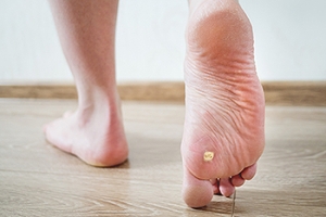 Why Do Plantar Warts Grow Inward?