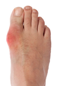 Foods That May Cause Gout