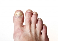 Is There A Link Between Obesity and Toenail Fungus?