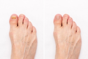 Facts About Toenail Fungus