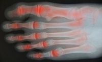 Arthritis and the Big Toe