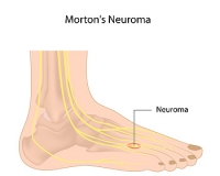 What You Should Know About Morton’s Neuroma