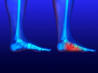 How to Determine If I Have Flat Feet
