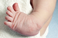 Dealing With Your Child's Clubfoot