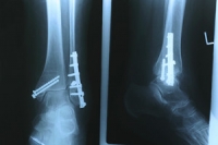 What Causes a Stress Fracture to Develop?