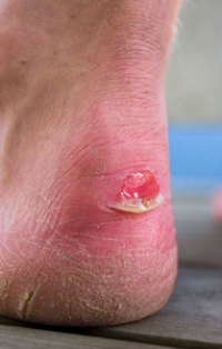 What Causes a Blister to Develop?